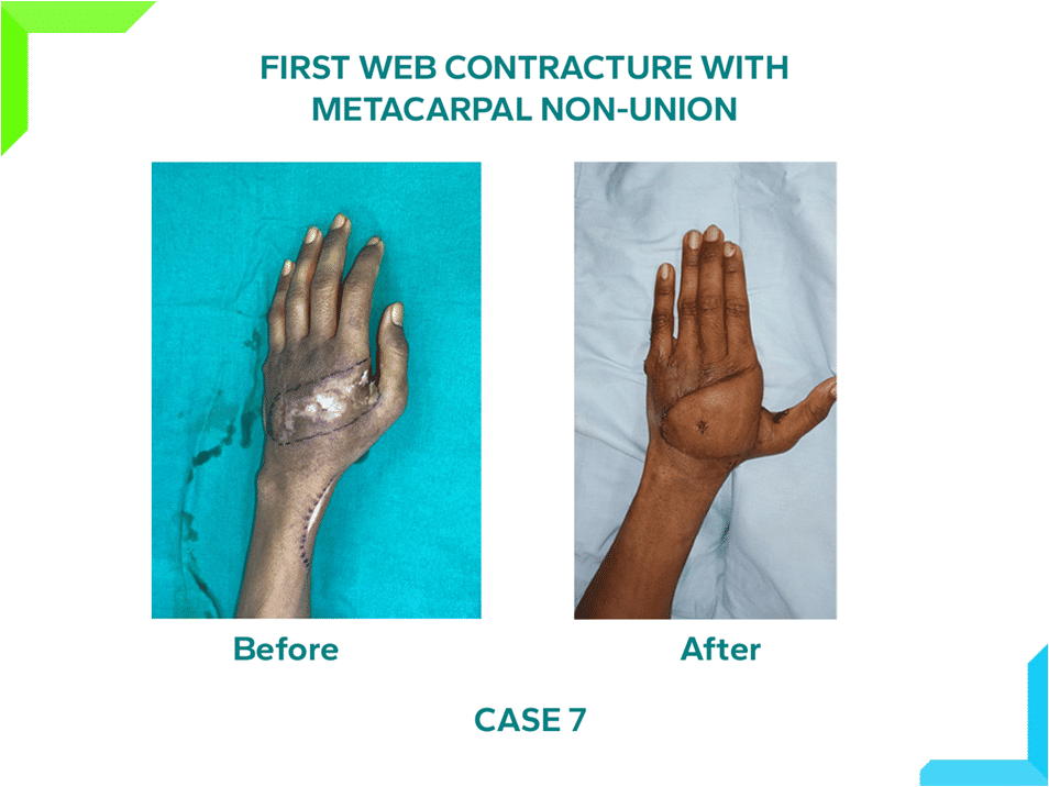 First Web Contracture First Web Contracture