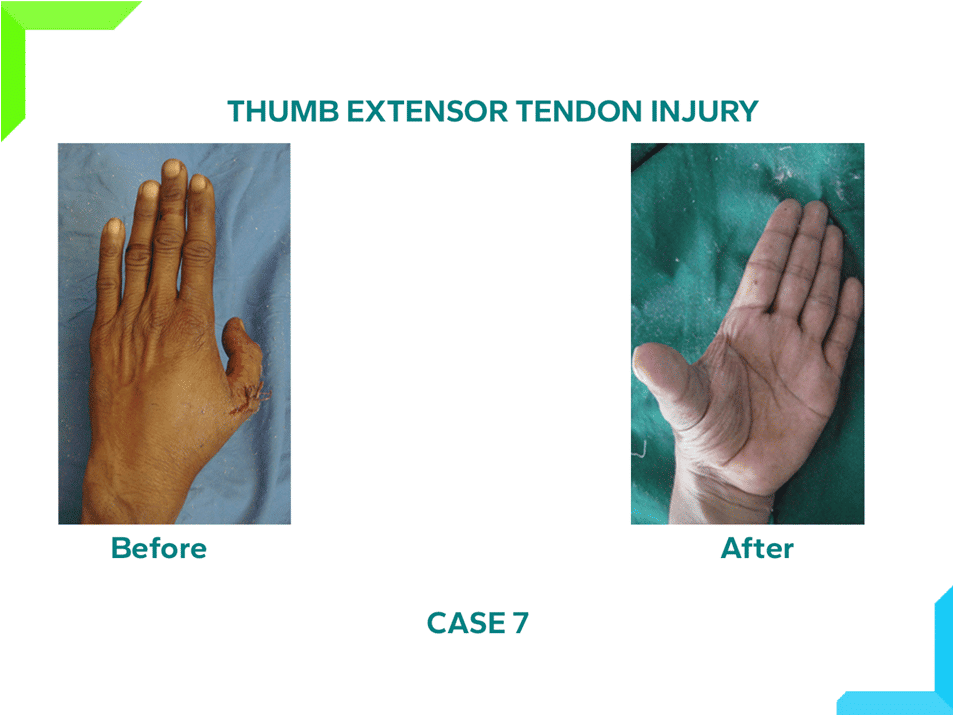 Thumb Extensor Tendon Injury Thumb Extensor Tendon Injury
