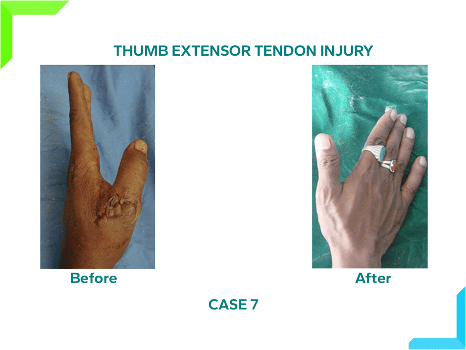 Thumb Extensor Tendon Injury Thumb Extensor Tendon Injury