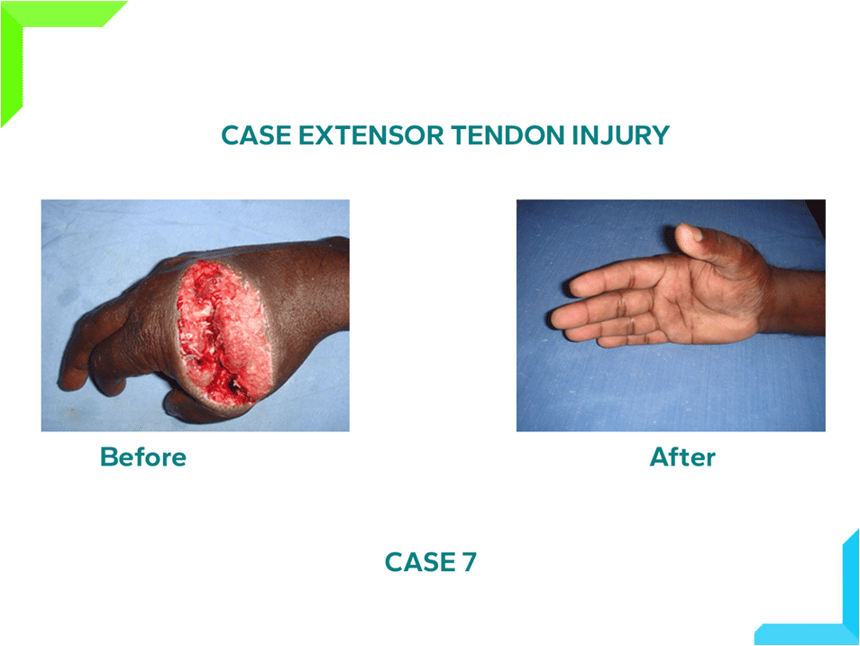 Extensor Tendon Injury Extensor Tendon Injury