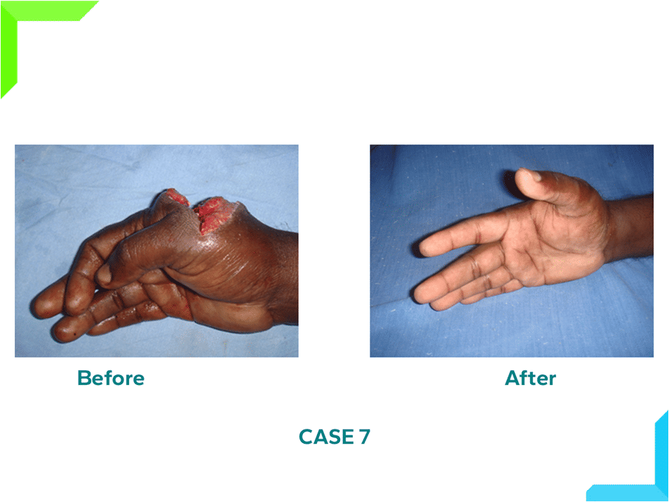 Extensor Tendon Injury Extensor Tendon Injury
