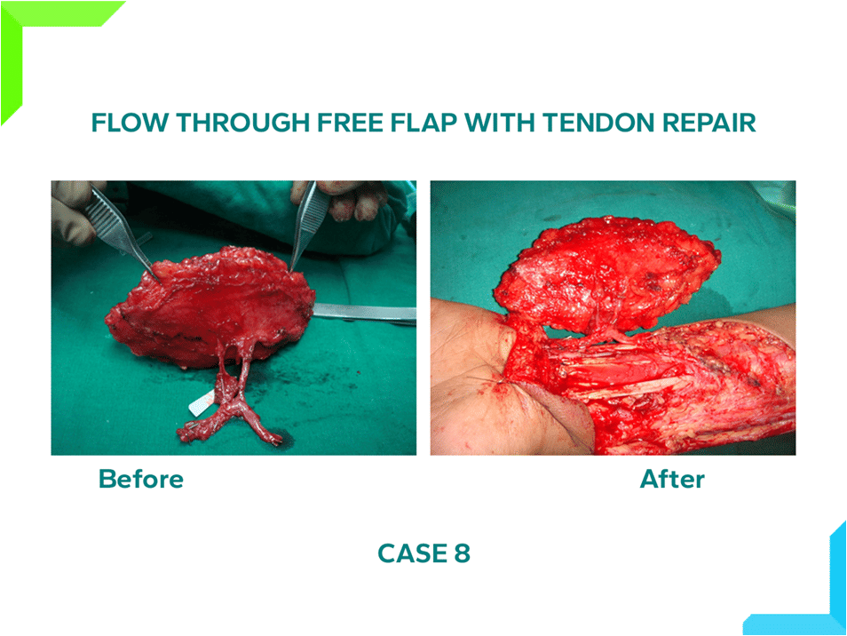 Free Flap With Tendon Repaired Free Flap With Tendon Repaired