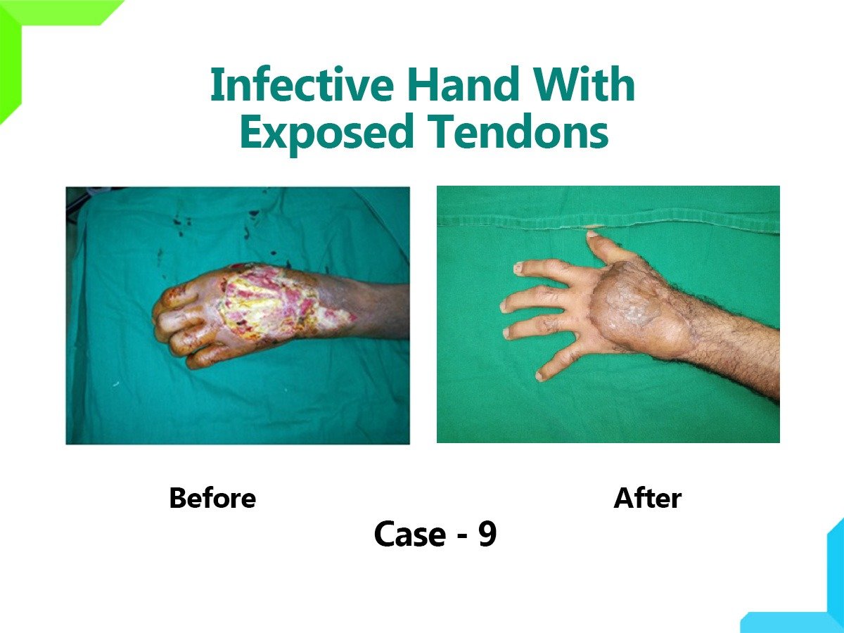 Infective Hand With Exposed Tendons Infective Hand With Exposed Tendons