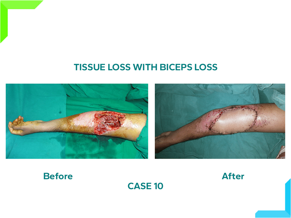 Tissue Loss Tissue Loss