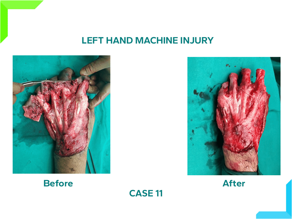 Left Hand machine injury Left Hand machine injury