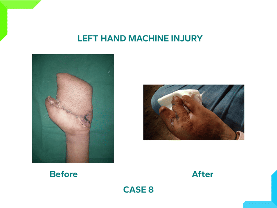 Left Hand machine injury Left Hand machine injury