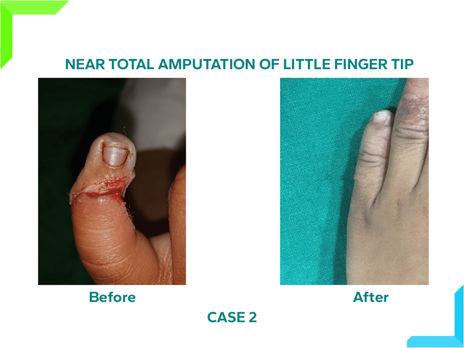 Near Total Amputation of Finger Near Total Amputation of Finger