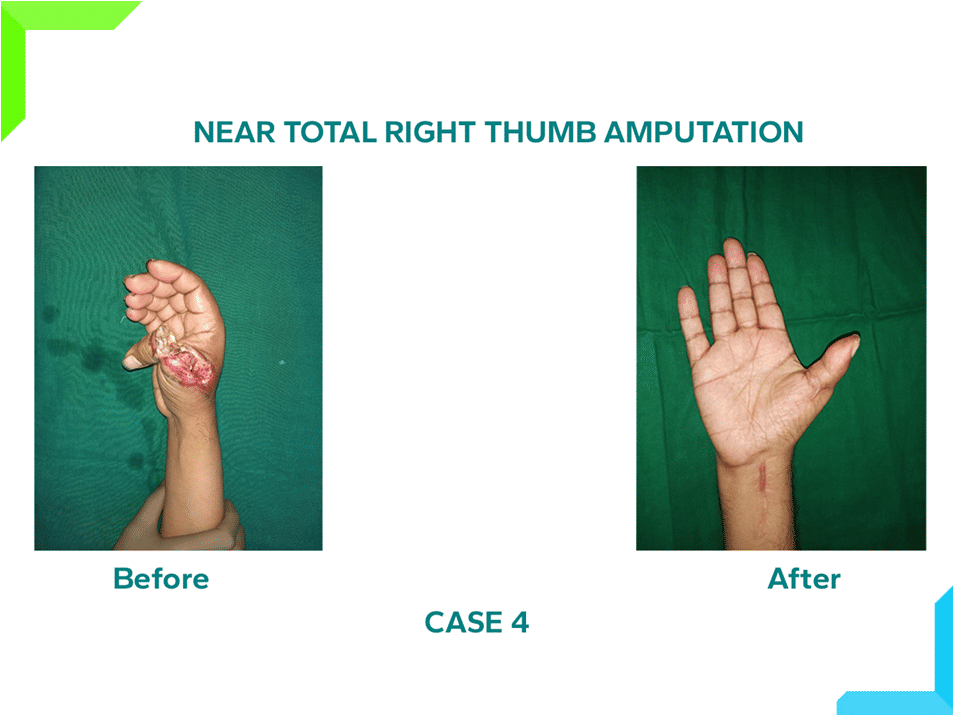 Near Total Right Thumb Amputation Near Total Right Thumb Amputation