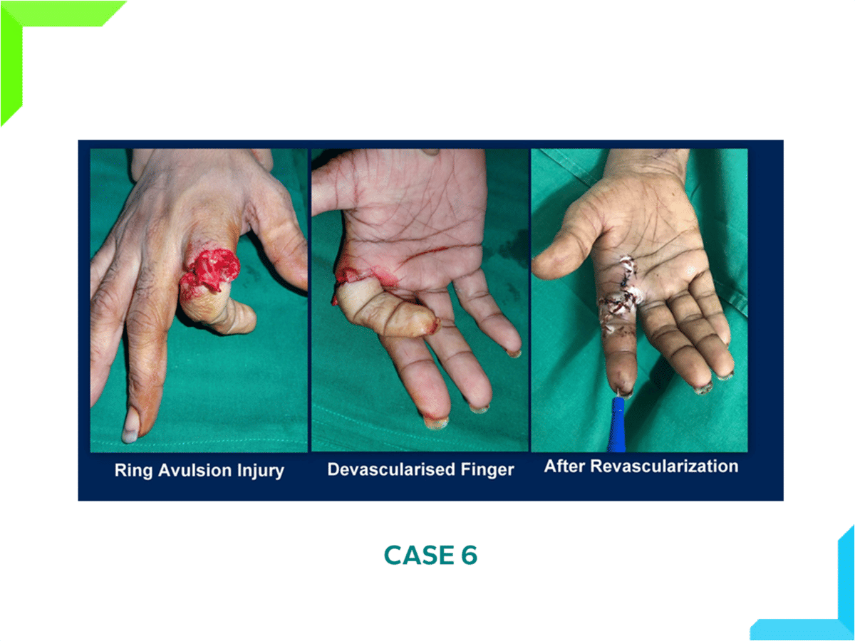 Finger injury Finger injury