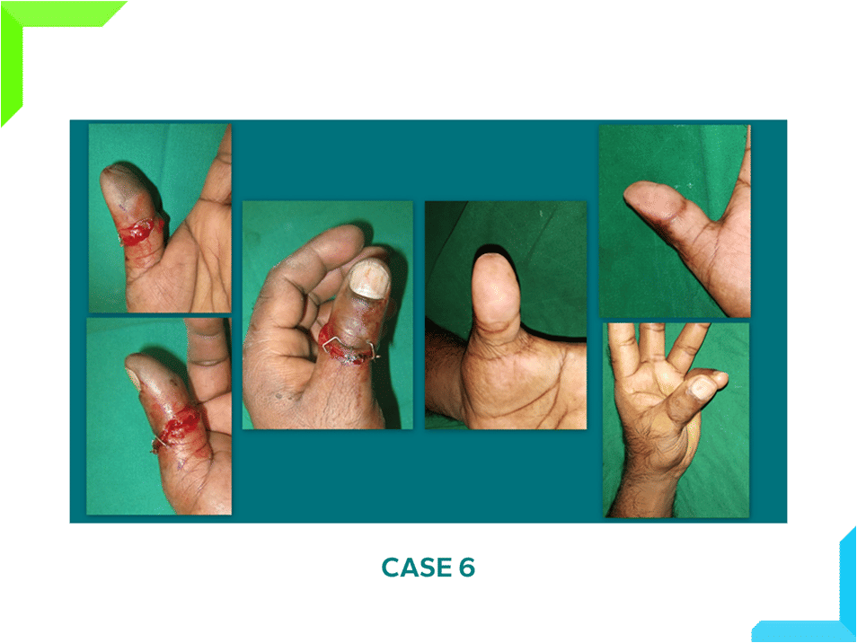Thumb Injury Thumb Injury