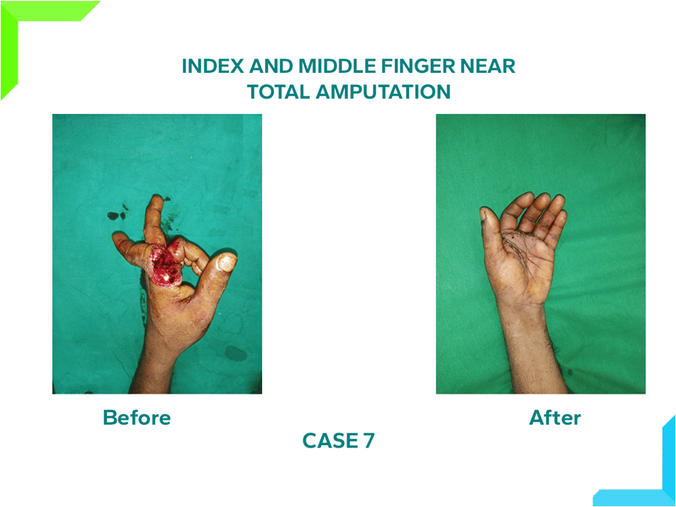 Index and middle Finger Near Total Amputation Index and middle Finger Near Total Amputation