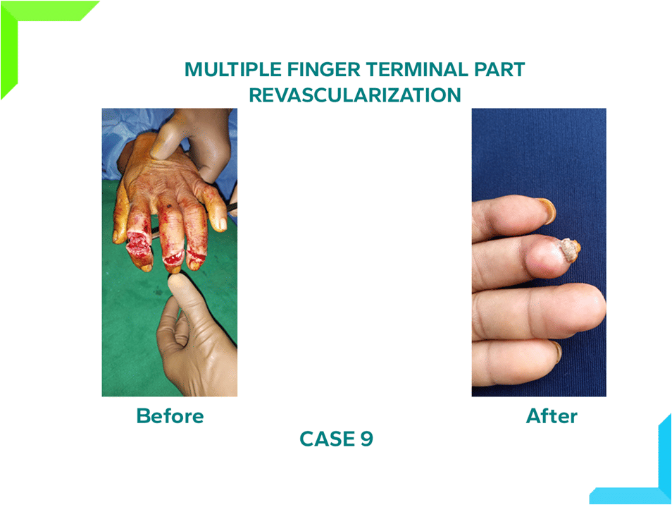 revascularization revascularization