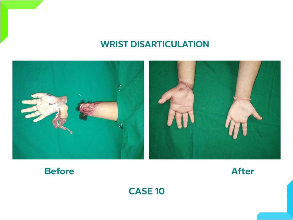 Wrist Disarticulation Wrist Disarticulation