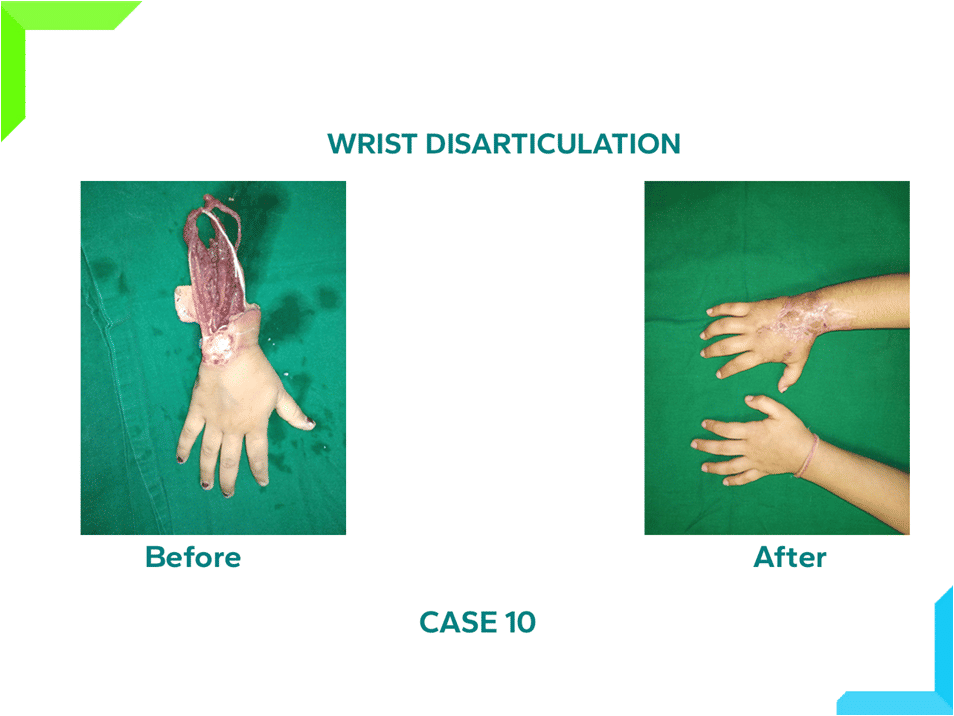 Wrist Disarticulation Wrist Disarticulation