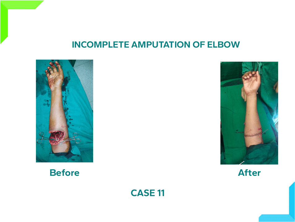 Amputation of Elbow Amputation of Elbow