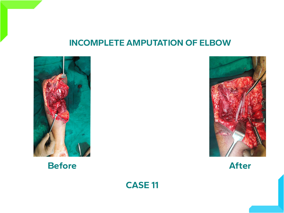 Amputation of Elbow Amputation of Elbow