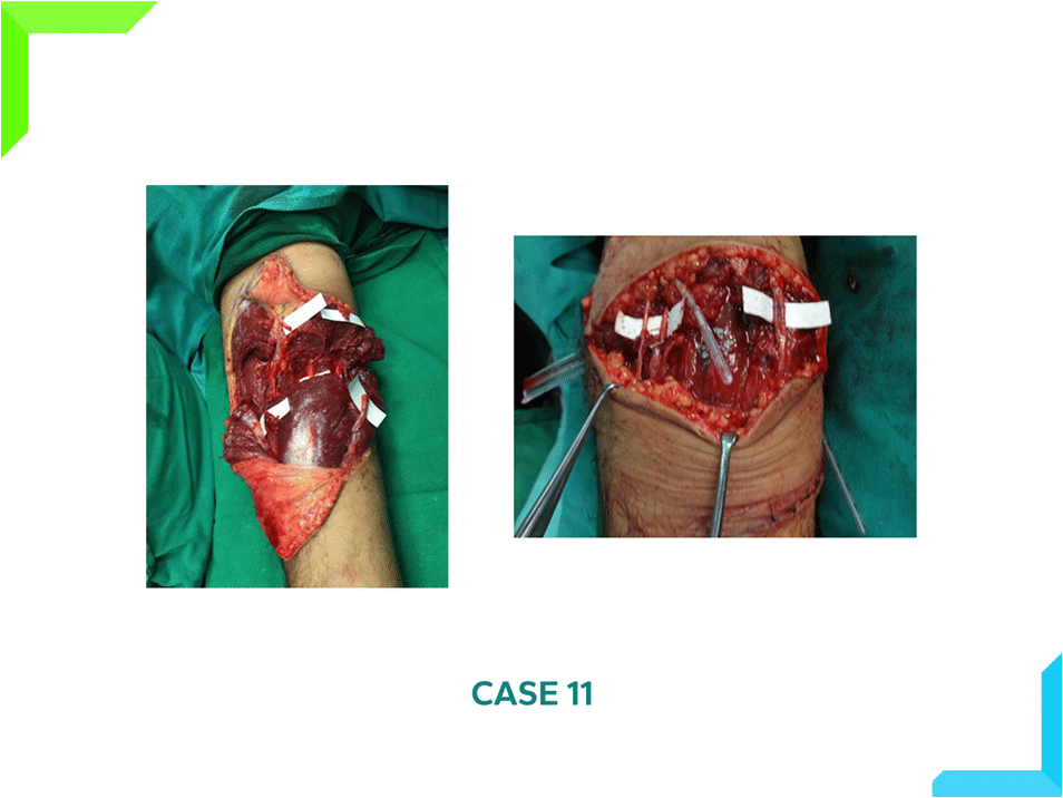 Amputation of Elbow Amputation of Elbow