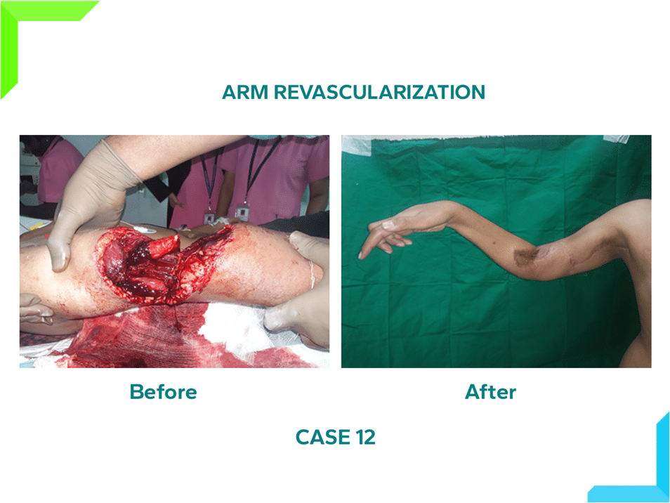 Arm revascularization Arm revascularization