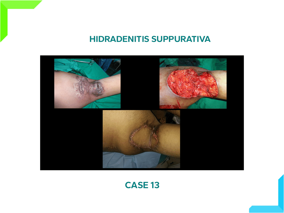 Hidradenitis Suppurativa Hidradenitis Suppurativa