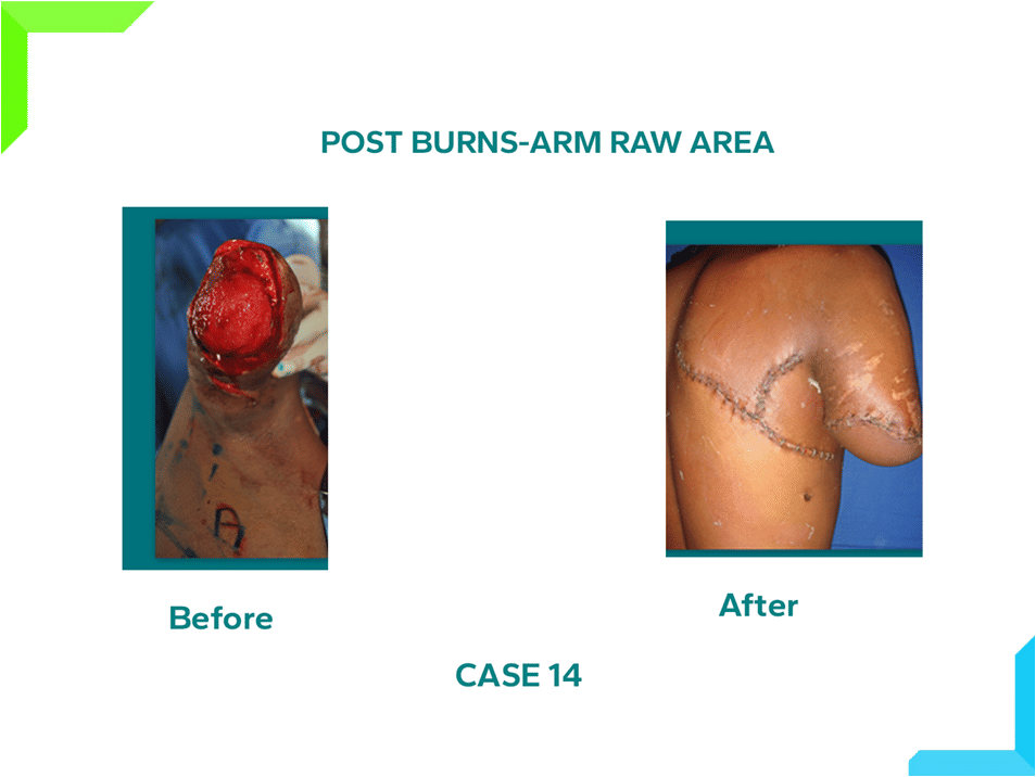Post Burn Arm Raw Area Post Burn Arm Raw Area
