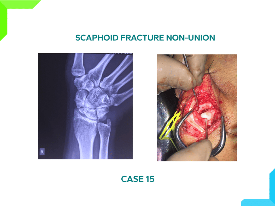 Scaphoid Fracture Non Union Scaphoid Fracture Non Union