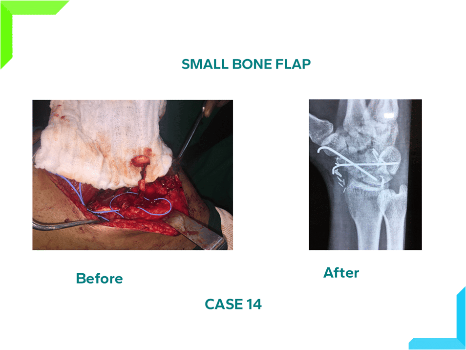 Small Bone Flap Small Bone Flap