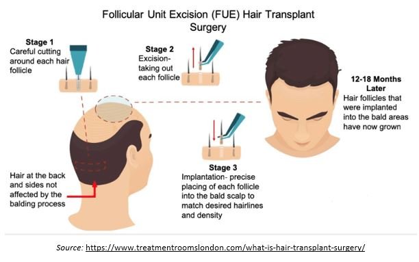 What to Expect at a Hair Transplant Clinic in Faridabad