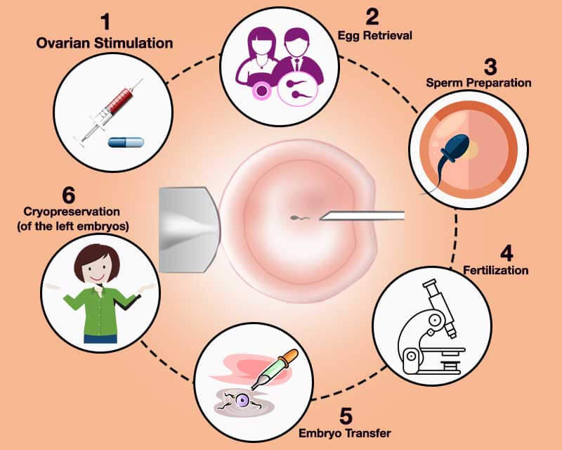 ICSI