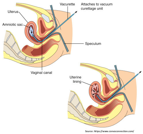 Vacuum Aspiration 