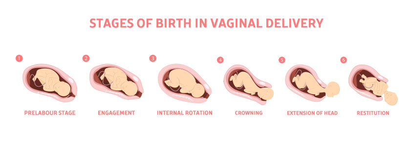 Stage of Birth In Vaginal Delivery