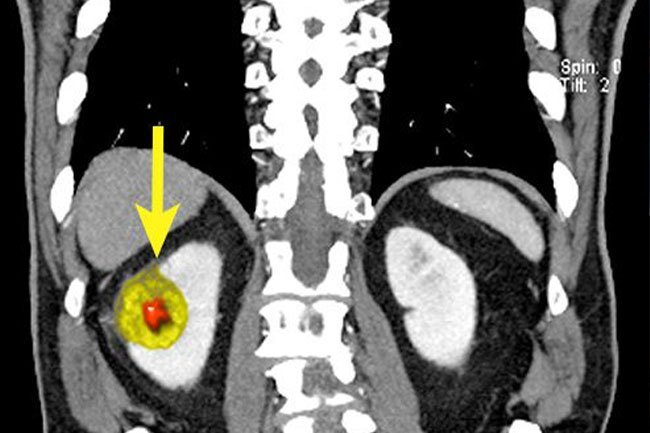 kidney cancer