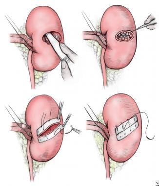 kidney cancer