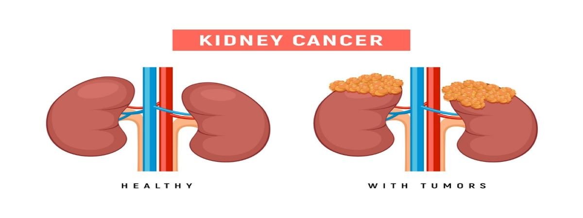 kidneystone kidneystone