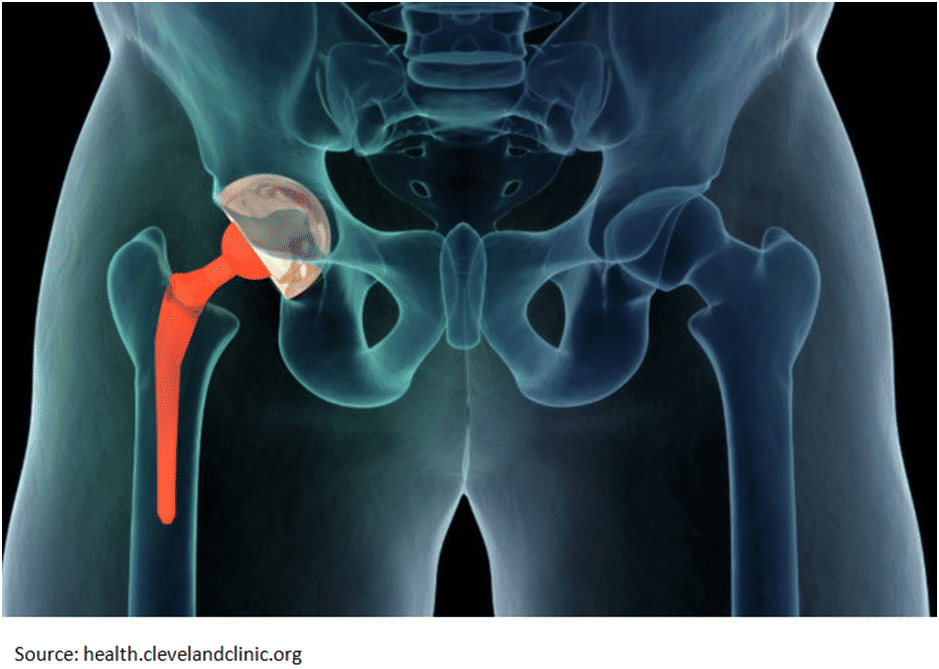 Physical Therapist's Guide to Total Hip Replacement (Arthroplasty)