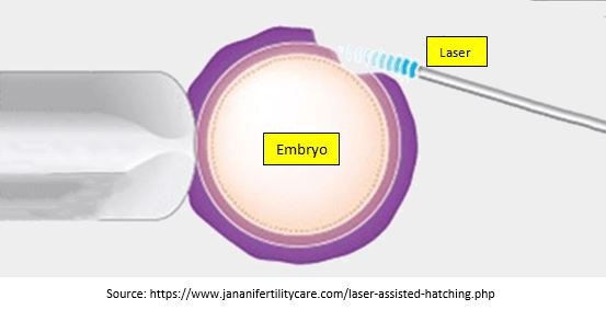 Laser Assisted Hatching
