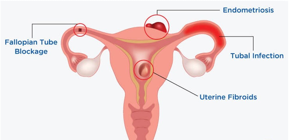 Endometriosis