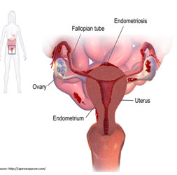 Endometriosis