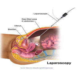 Laparoscopic surgery