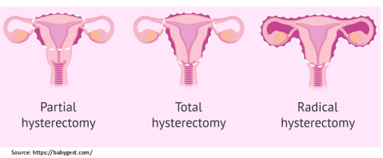 Hysterectomy