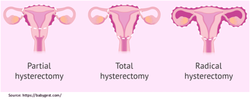 Hysterectomy