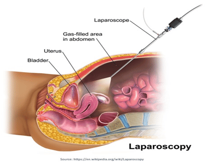 Laparoscopic surgery