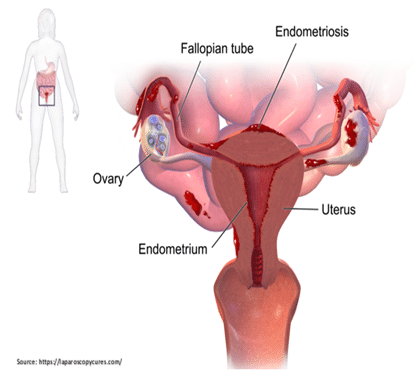 Endometriosis