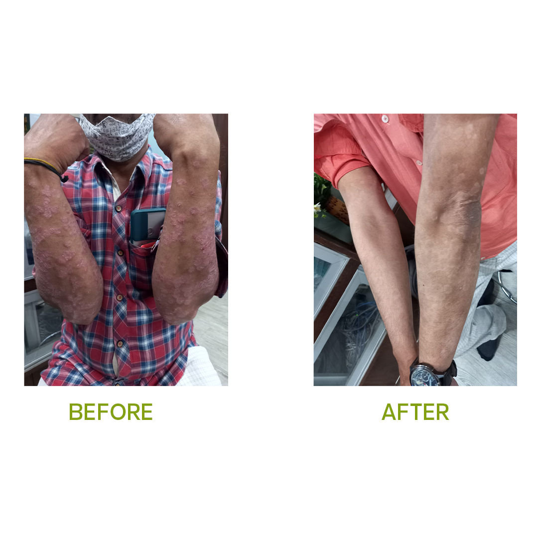 Psoriasis Treatment