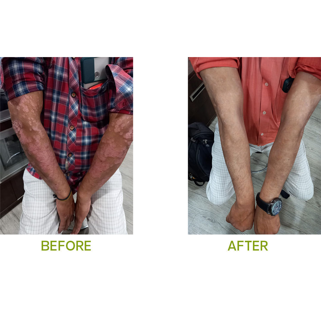 Psoriasis Treatment