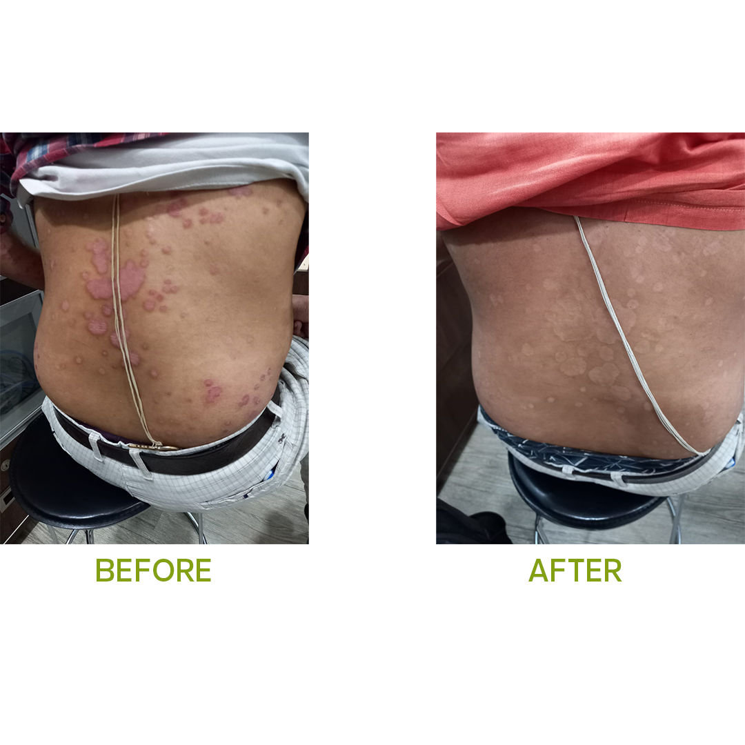 Psoriasis Treatment