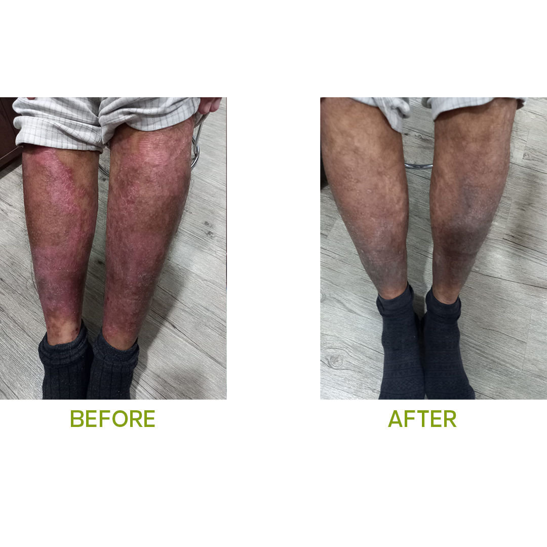 Psoriasis Treatment