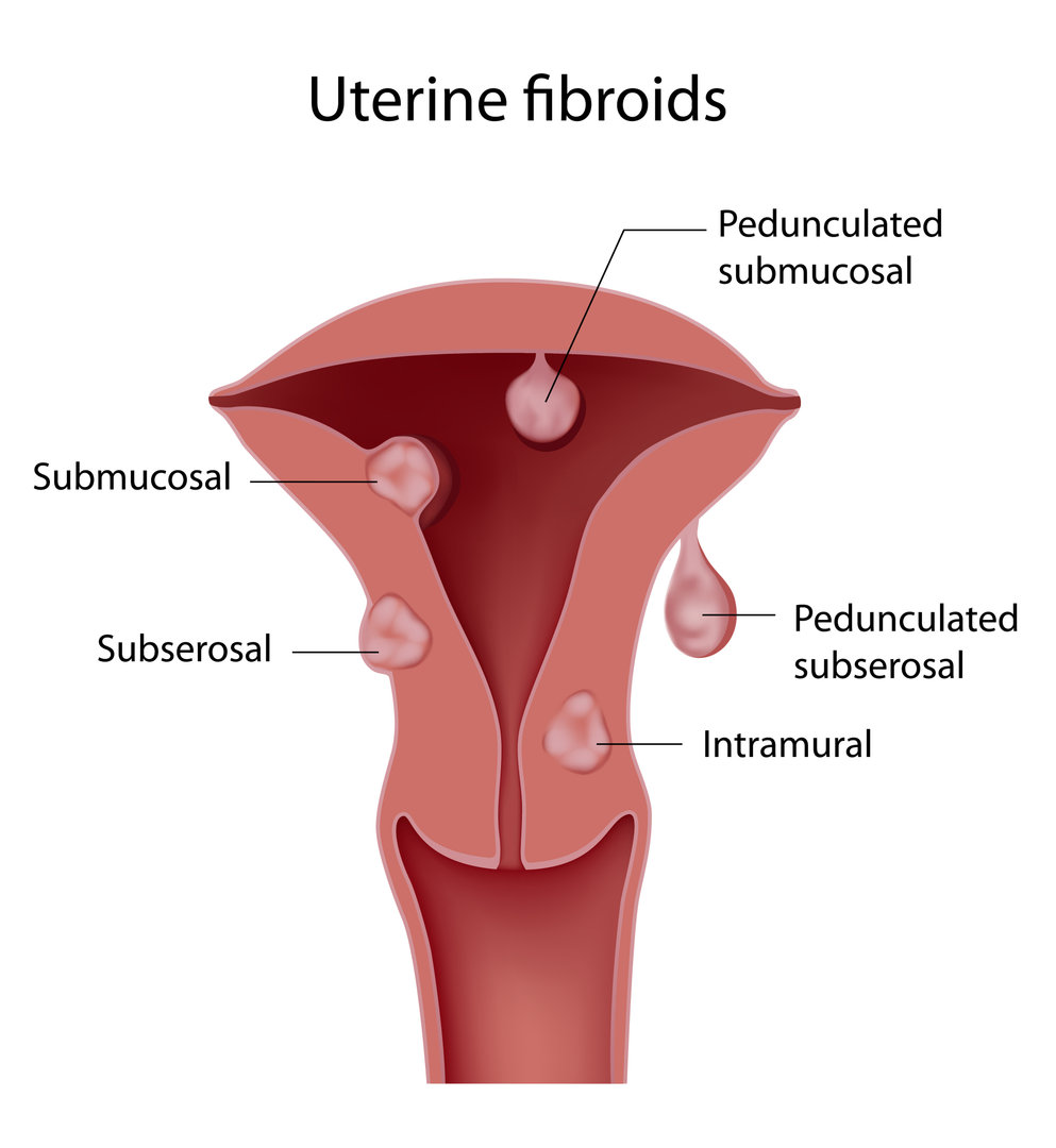  uterine fibroids