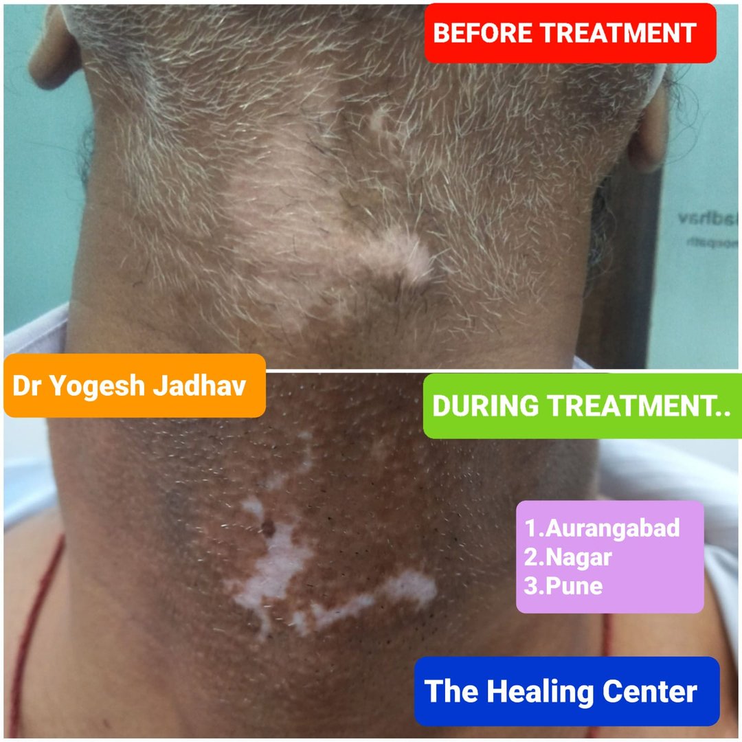 vitiligo treatment