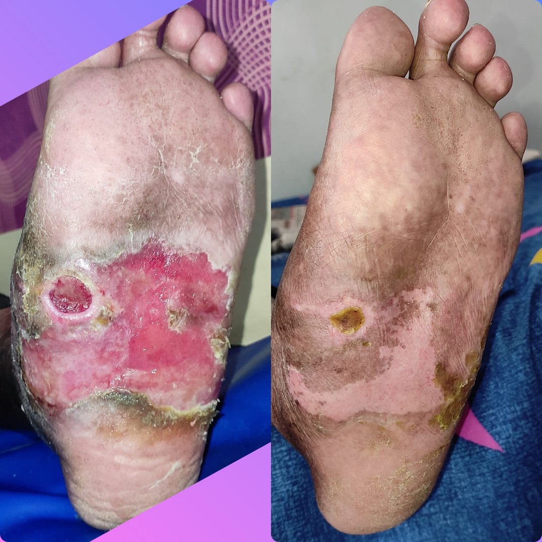 chronic wound chronic wound