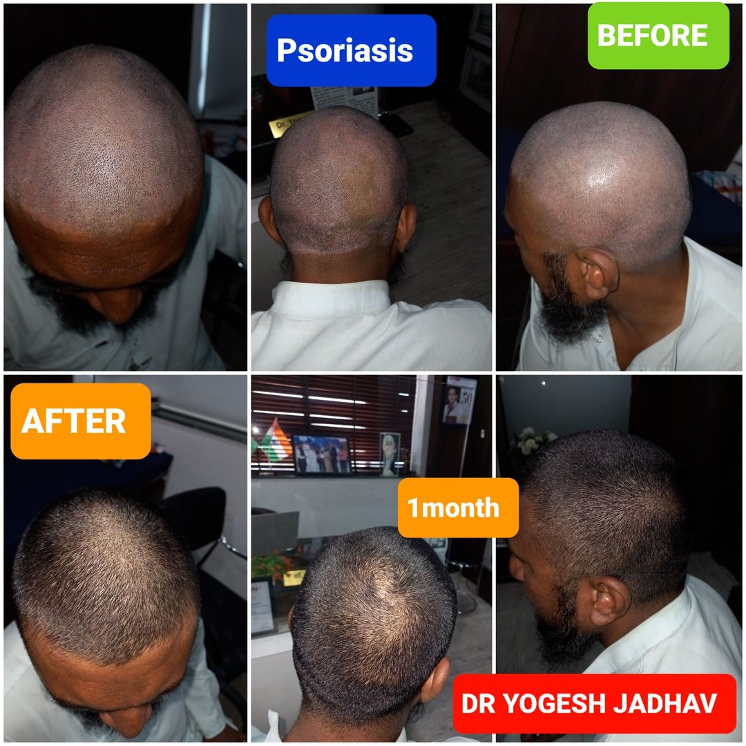 psoriasis treatment